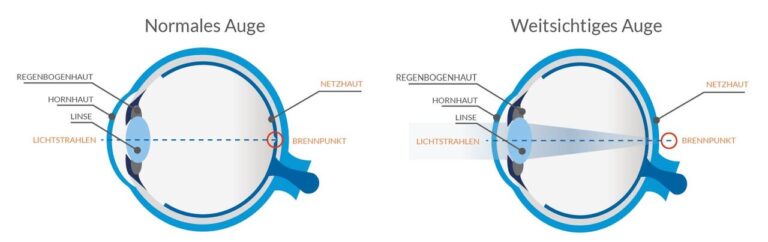 Altersweitsichtigkeit: Was eine wiedergewonnene klare Sicht nach dem 45. Lebensjahr kostet – und wert ist Altersweitsichtigkeit